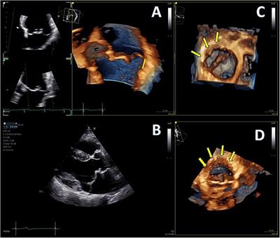 The added value of three-dimensional transthoracic echocardiography in mitral annular disjunction: a case report